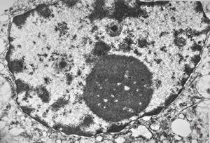 M,5y. | activated nucleolus - Reye hepatocerebral syndrome M,5y. | activated nucleolus - Reye hepatocerebral syndrome